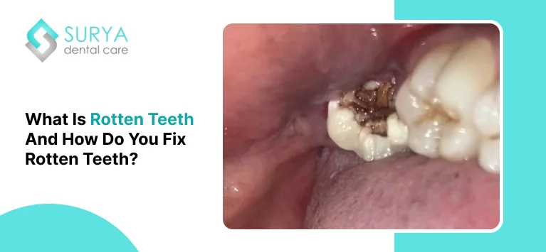 What is Rotten Teeth And How Do You Fix Rotten Teeth?