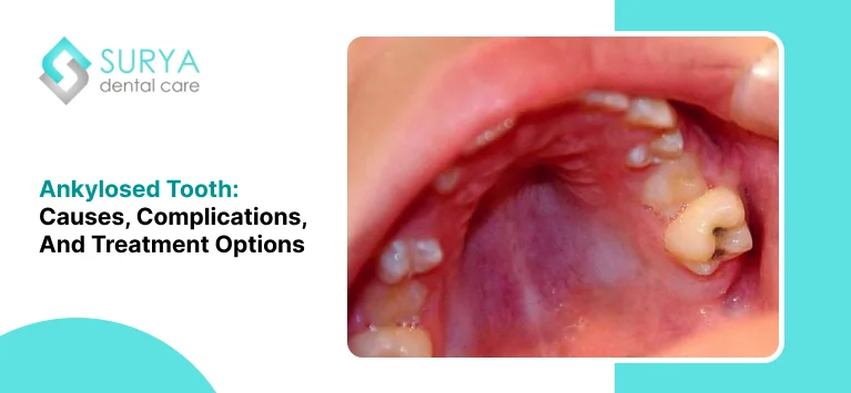 Ankylosed Tooth