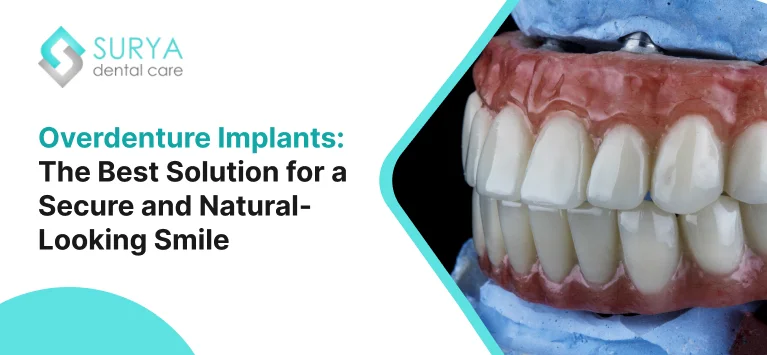 Overdenture Implants