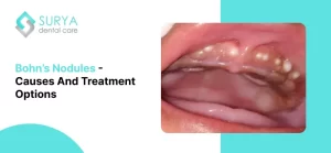 Bohn's Nodules pictures