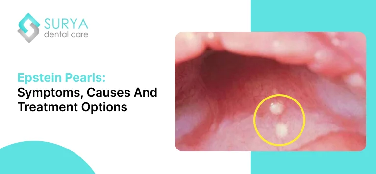 Epstein Pearls: Symptoms, Causes and Treatment Options