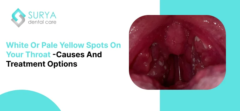 White or Pale Yellow Spots on Your Throat